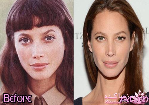 جراحی بینی - جراحی زیبایی